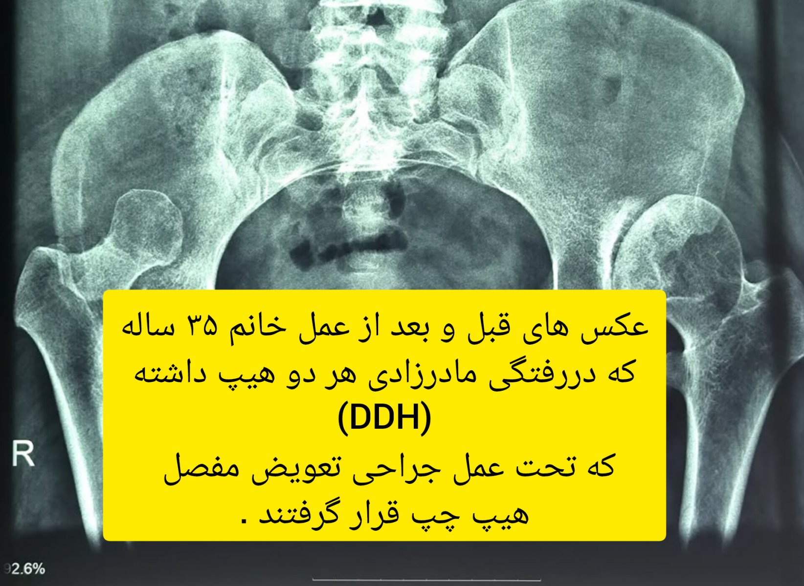 DDH هیپ دو طرفه