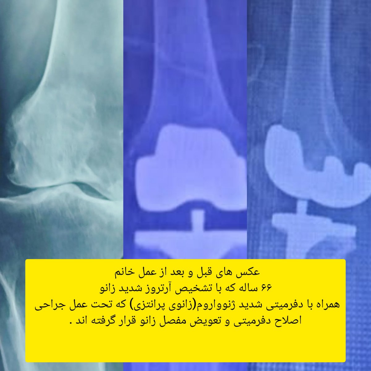 تعویض مفصل زانو با ارتروز شدید زانو همراه با دفرمیتی شدید ژنوواروم ( زانوی پرانتزی )